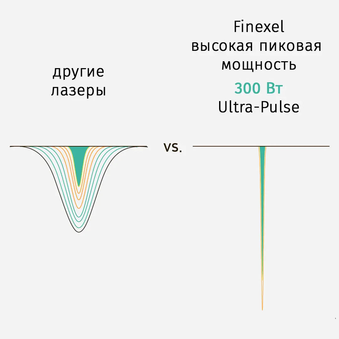 Иллюстрация технологии ультраимпульса Finexel
